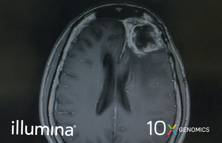 Glioblastoma