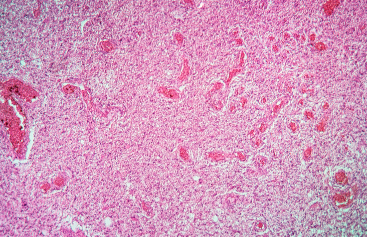 Glioma sample