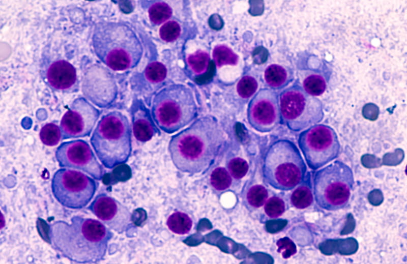 Bone marrow cancer cells